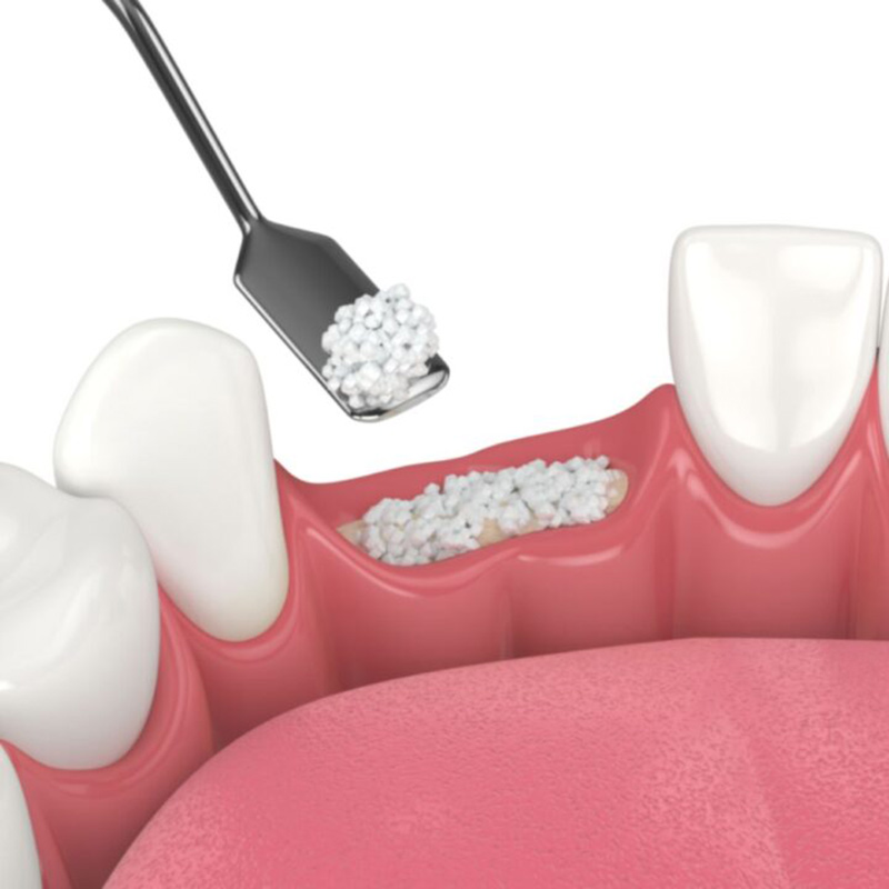 We Provide Bone Grafting in Parker, CO